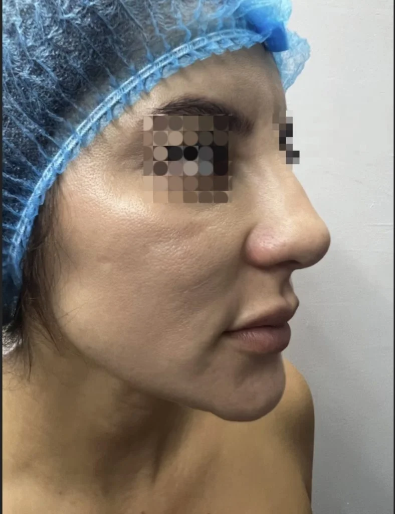 rinoplastia