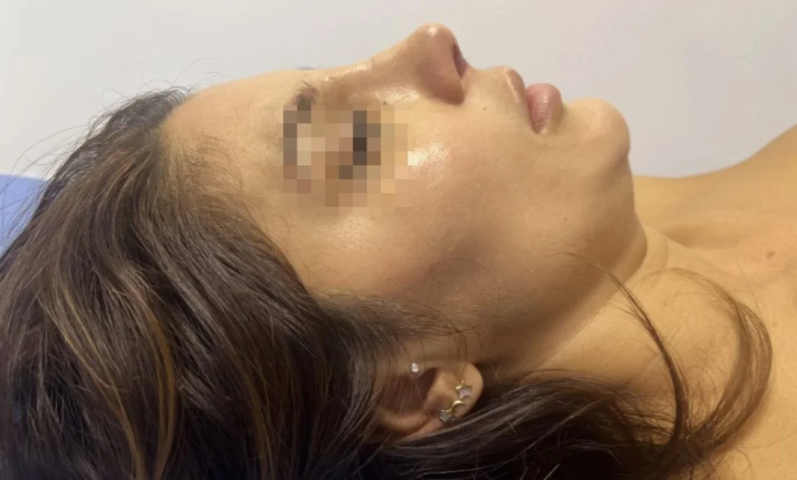 cirugia estetica de rinoplastia